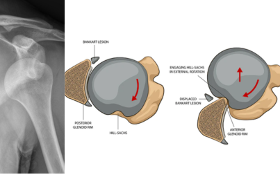 Learn about shoulder dislocation and surgeries to prevent further dislocation 
