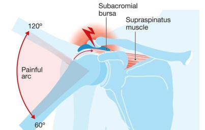 Learn about Shoulder Impingement syndrome